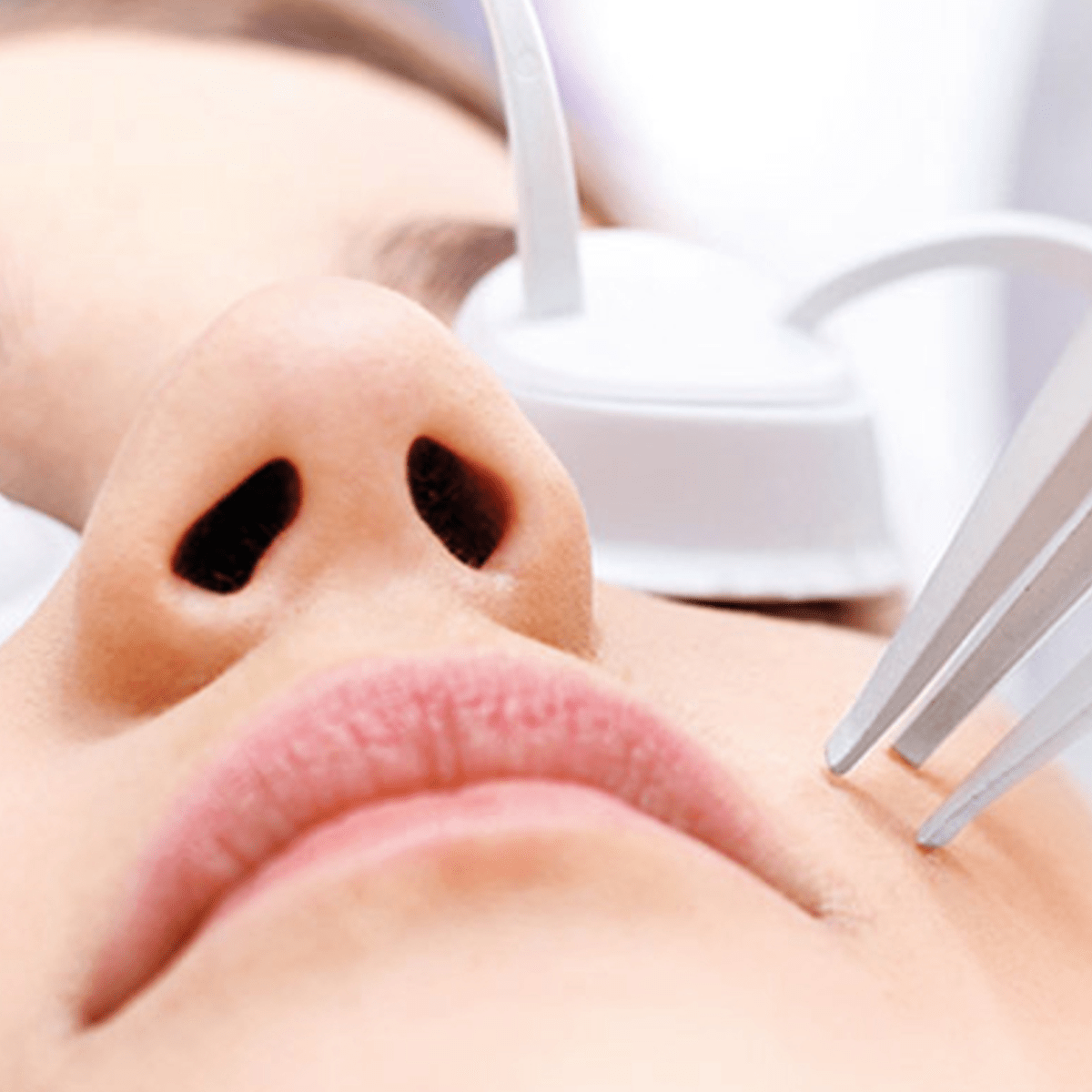 Laser treatment on face  Title: Laser treatmeht on the face of a young woman